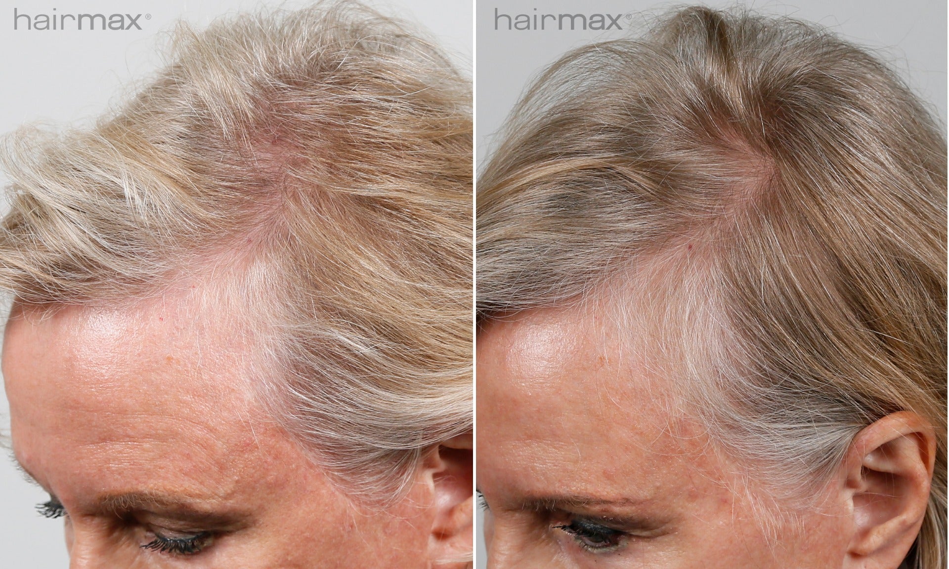 Hairmax LaserCap Power Flex 272