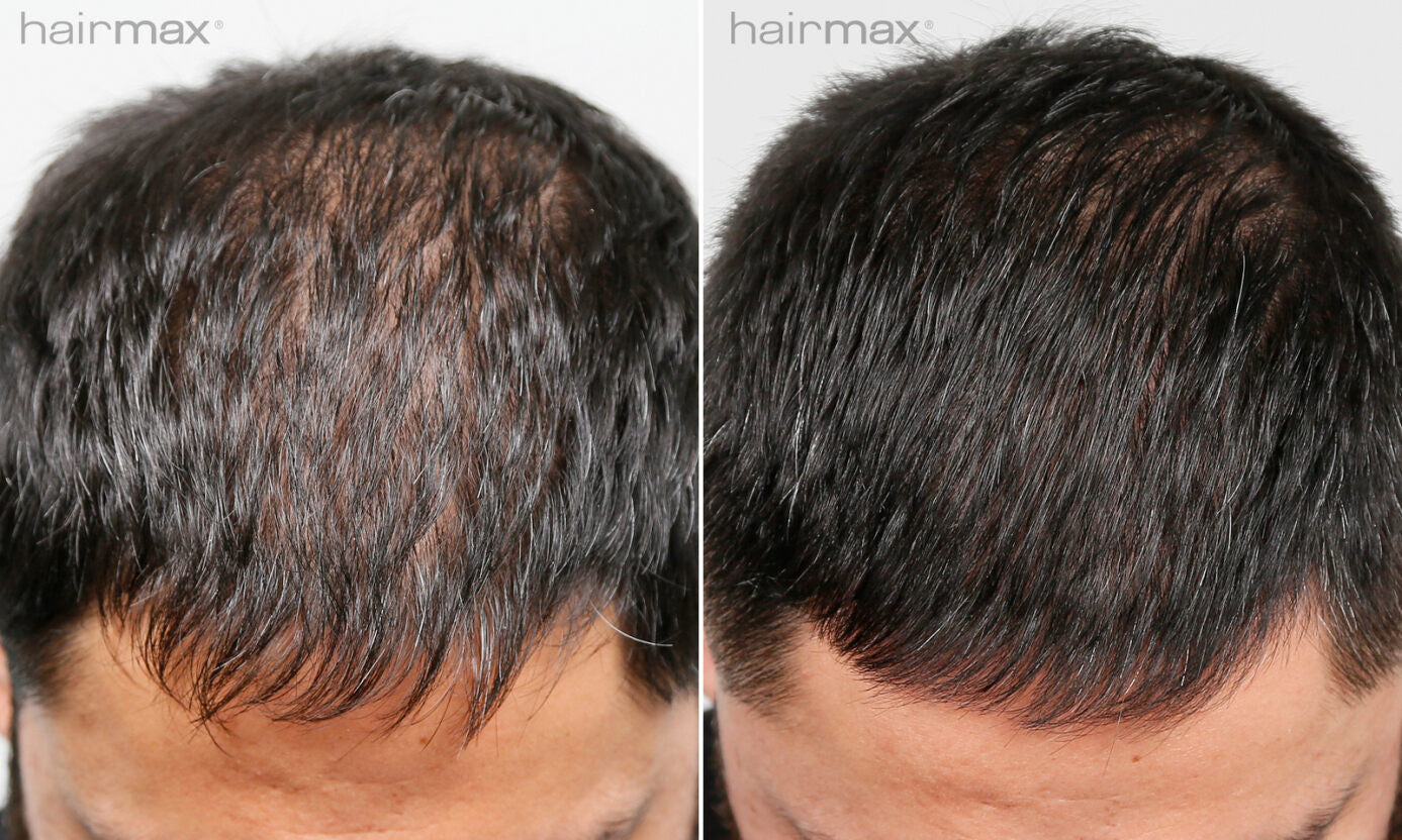 Hairmax LaserCap Power Flex 272