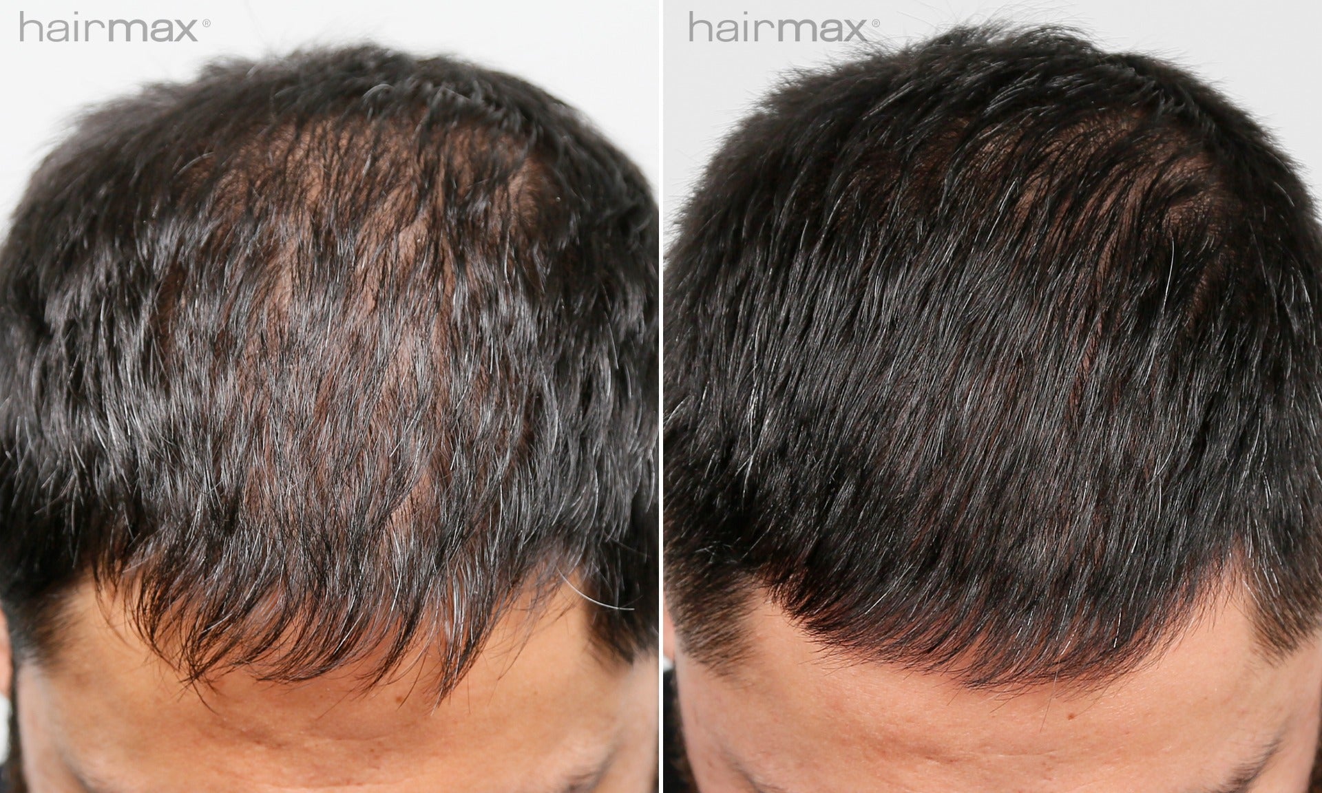 Hairmax LaserComb Ultima 12